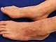 15 meilleurs remèdes contre l'eczéma